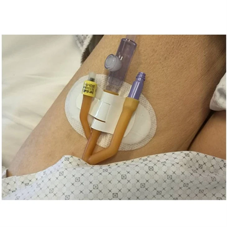 Urinary Catheter Securement Dressing